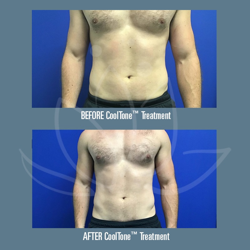Before and After Photos of CoolTone Treatment