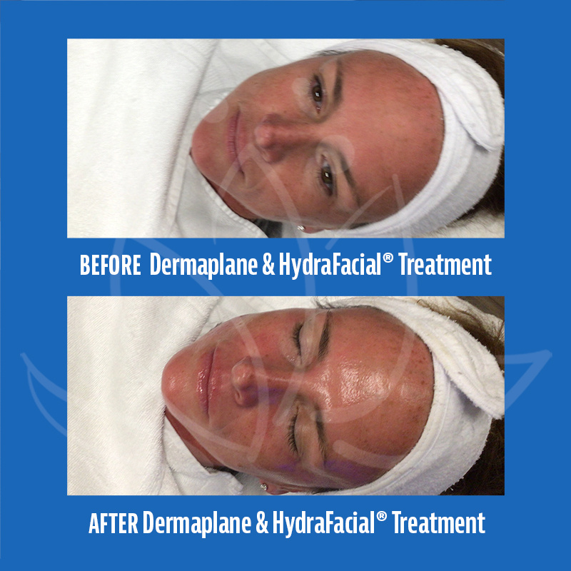 Before and After Photos of Hydrafacial Treatment