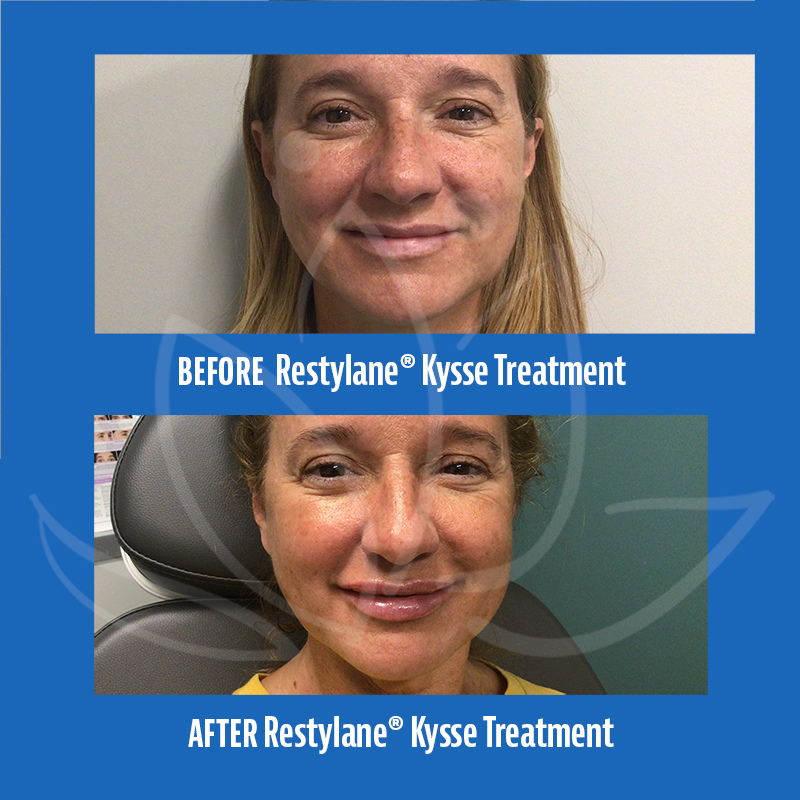 Before and After Photos of Restylane Kysse Treatment