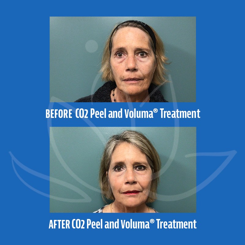 Before and After Photos of C02 Peel and Voluma Treatment