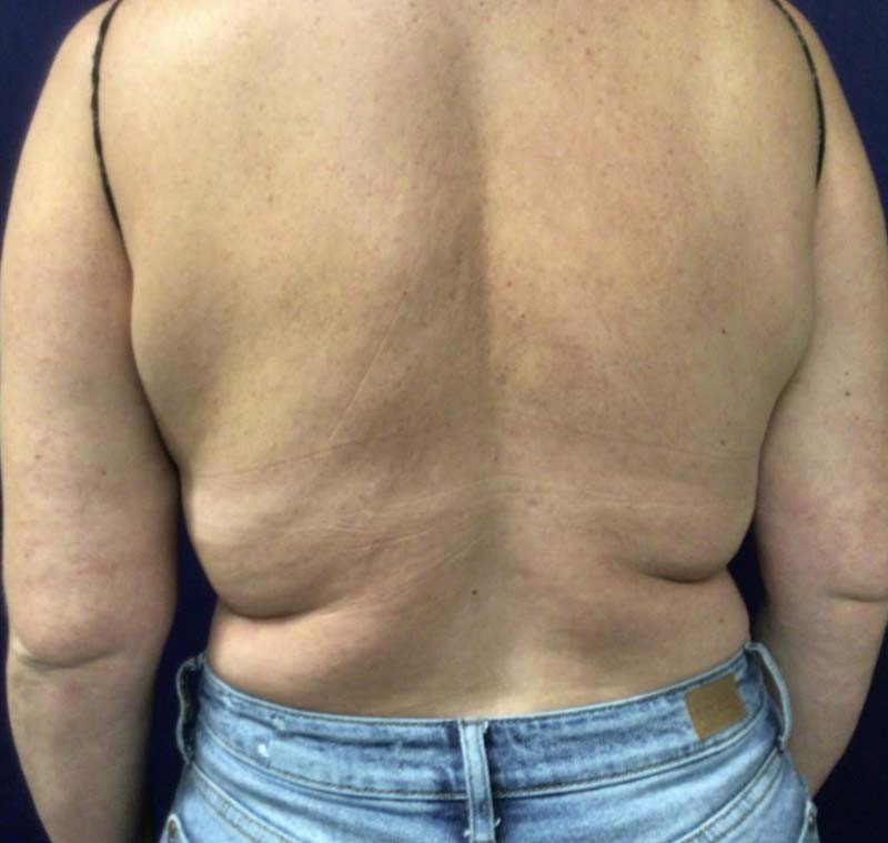 Brastrap CoolSculpt Before Brastrap CoolSculpt Before