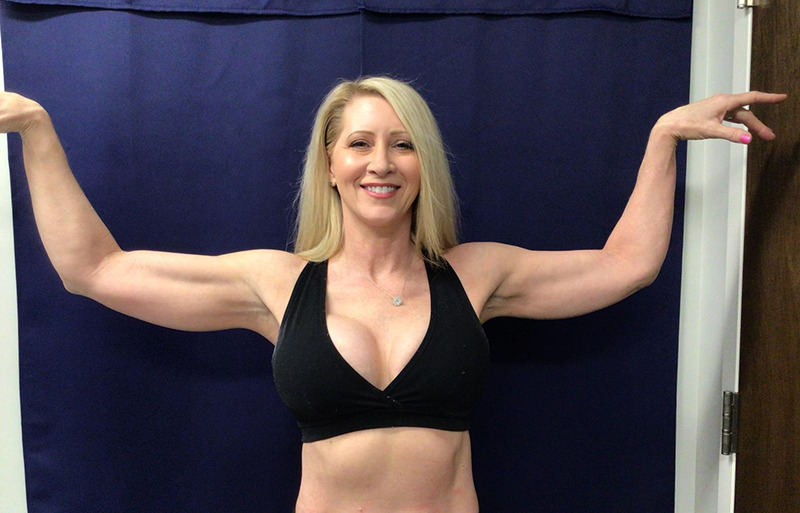 Arms Cool Sculpting and NuEra Tight (Fire & Ice) After Arms Cool Sculpting and NuEra Tight (Fire & Ice) After