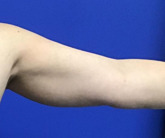 Cool Sculpting Arms Before