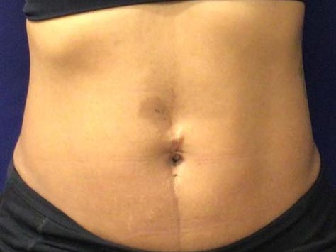 CoolSculpting Abs After
