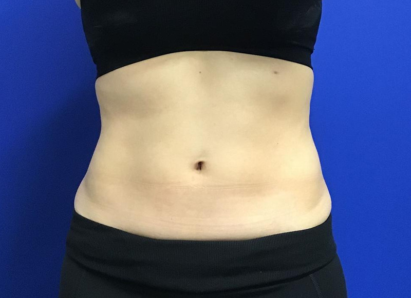 CoolSculpting Abs After CoolSculpting Abs After