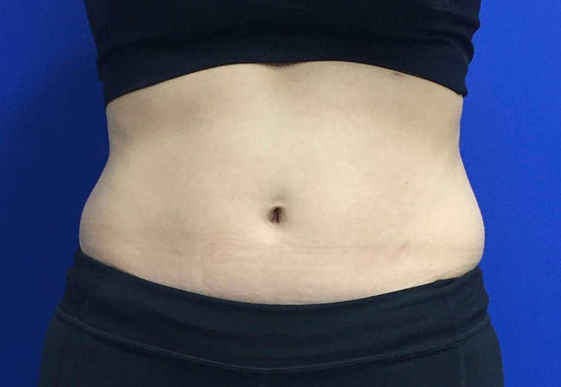 CoolSculpting Abs Before