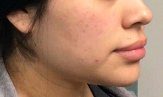 Microneedling for Acne After