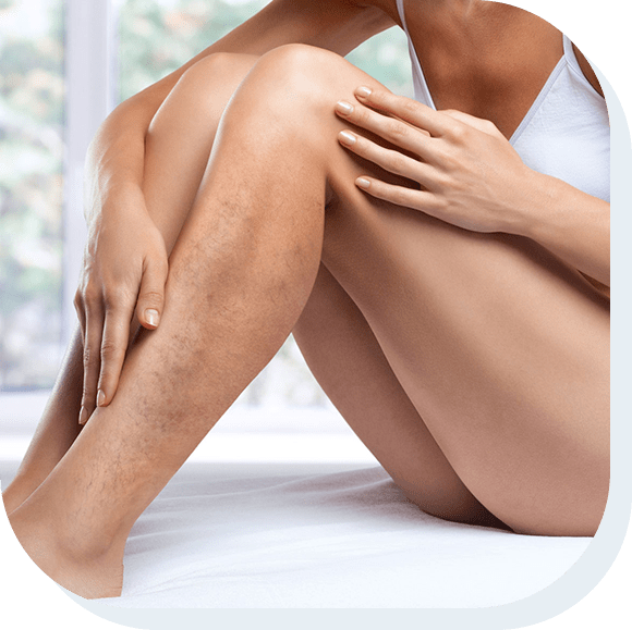 asclera spider vein treatment in lawrenceville georgia