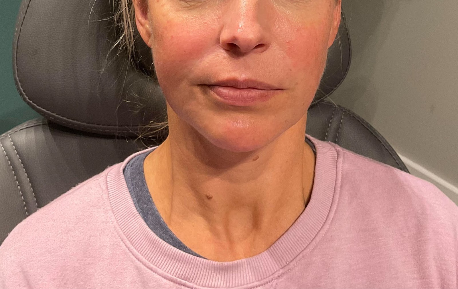 Juvederm Vollure and ultra plus before