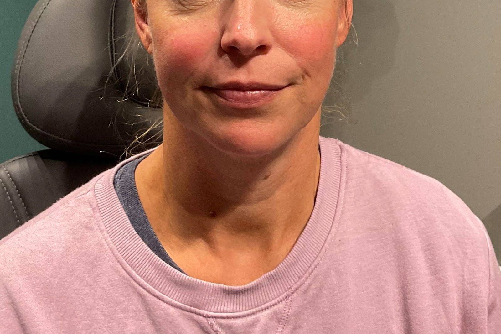 Juvederm Vollure and ultra plus after