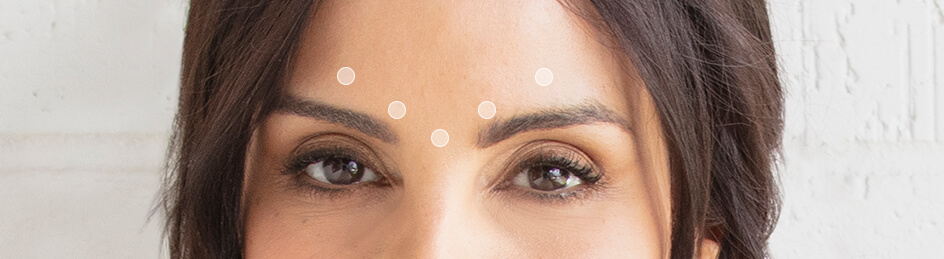 Dysport for wrinkles and fine lines. 