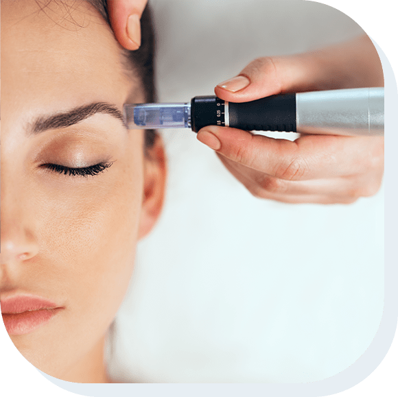 Closeup of a young woman receiving microneedling treatment