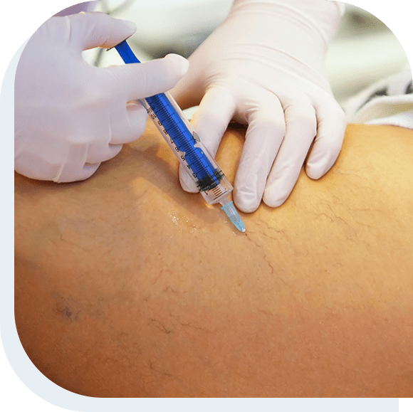 Vein Treatment