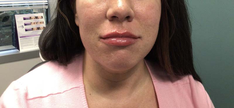 After Lips Kysse Vollure