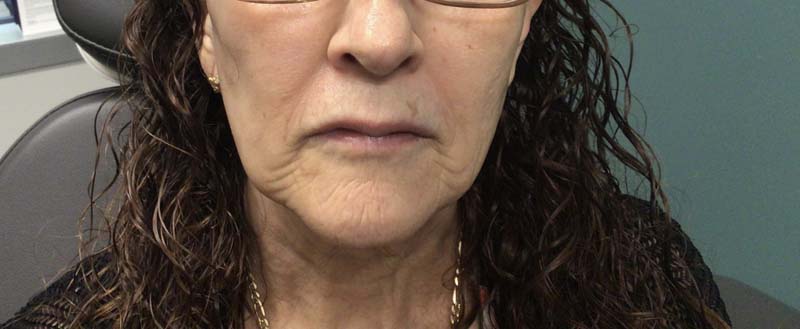 Botox & Juvederm Before