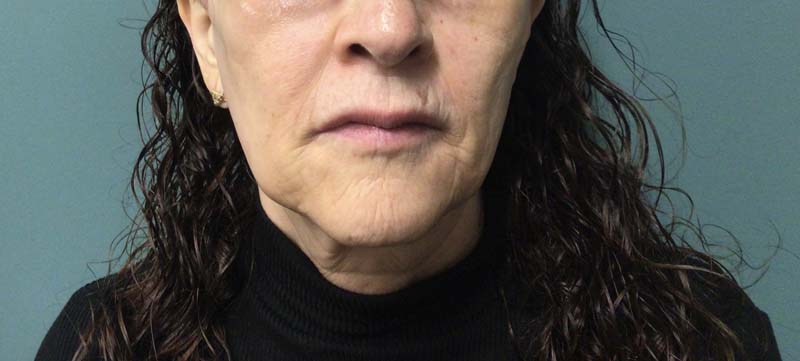 Botox & Juvederm After