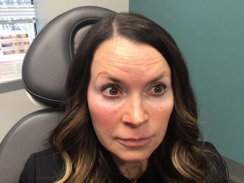 BOTOX BEFORE