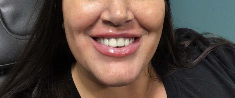 JUVEDERM AFTER