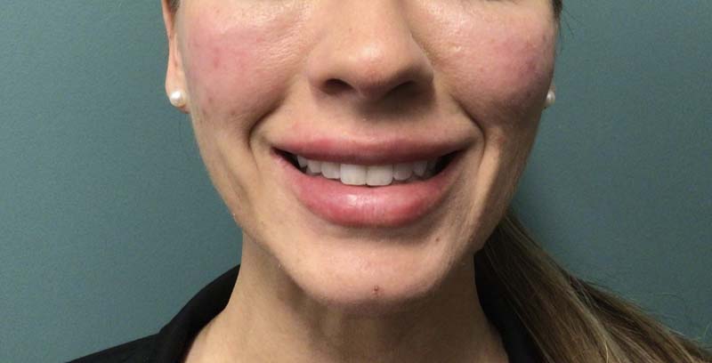 Juvederm Vollure AFTER
