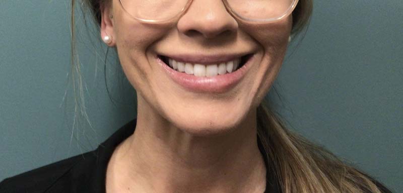 Juvederm Vollure before