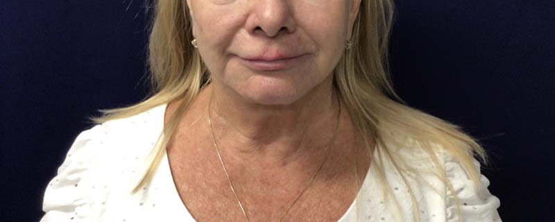 RESTALYN CHIN BEFORE