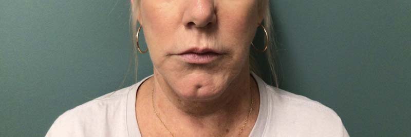 RESTALYN LIPS BEFORE