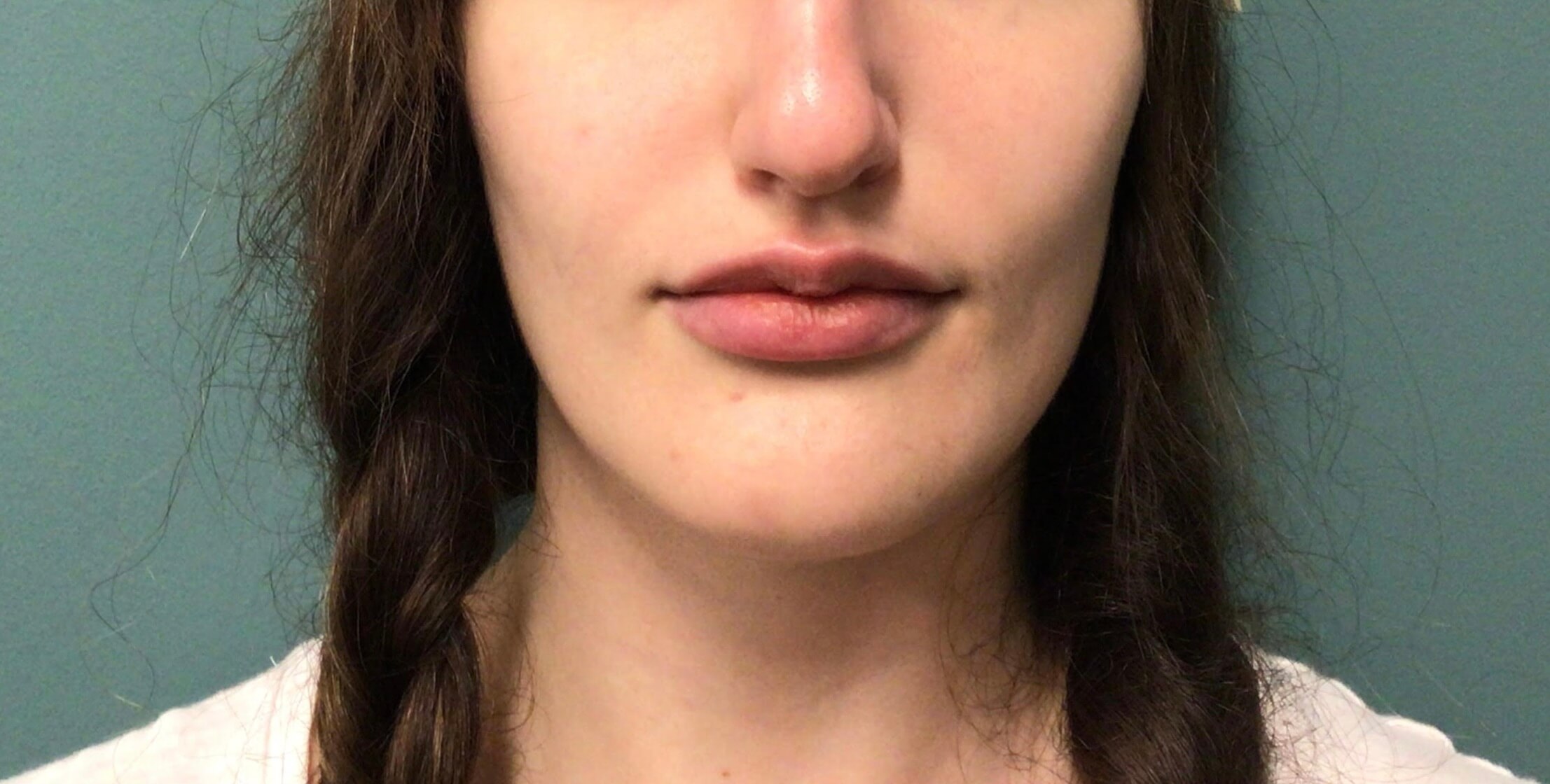 juvederm Vollure AFTER