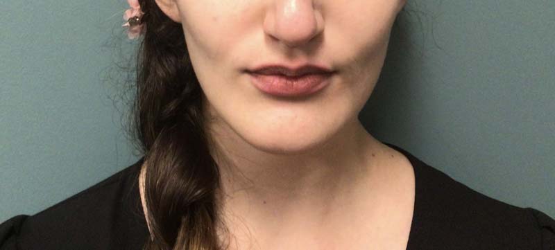 Juvederm Vollure Lips Before