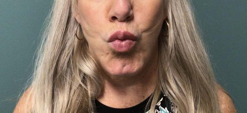 Restylane Vertical Lip Lines After