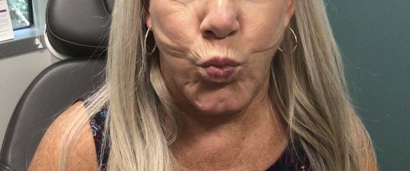 Restylane Vertical Lip Lines Before