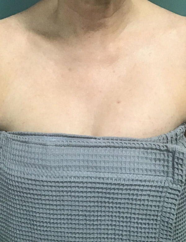 Chest IPL Laser After
