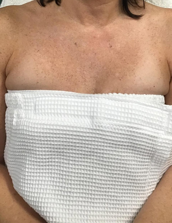 Chest IPL Laser Before