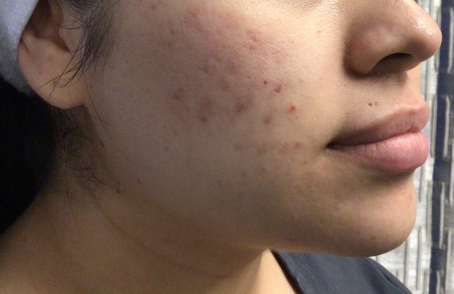 Microneedling for Acne Before