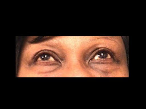 After Volbella Treatment