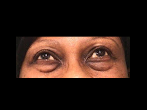 Before Volbella Treatment