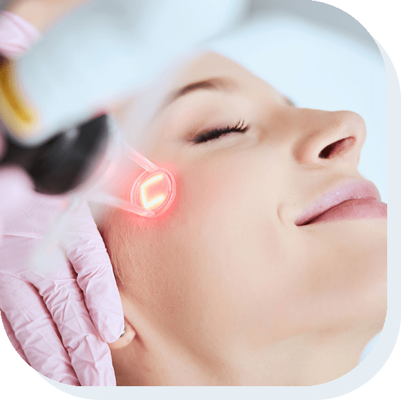 acupulse fractioned c02 treatment in lawewnceville georgia