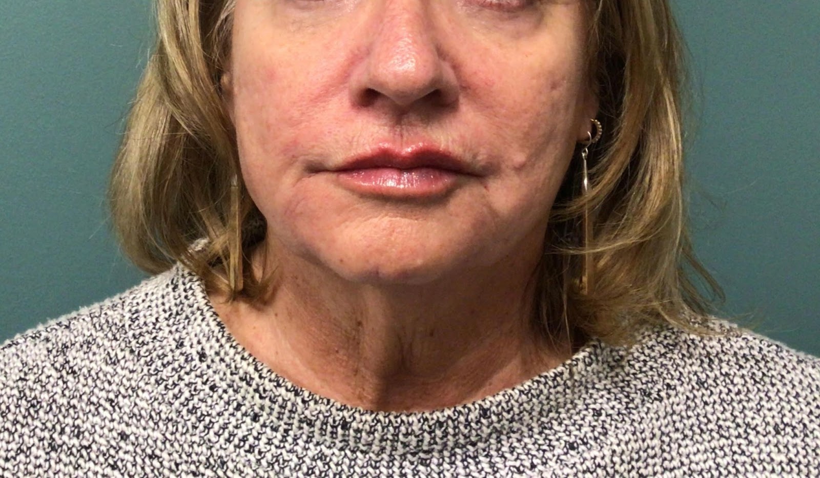 Juvederm After