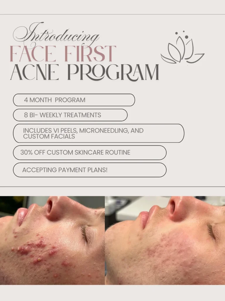 MadEmEl Acne Program