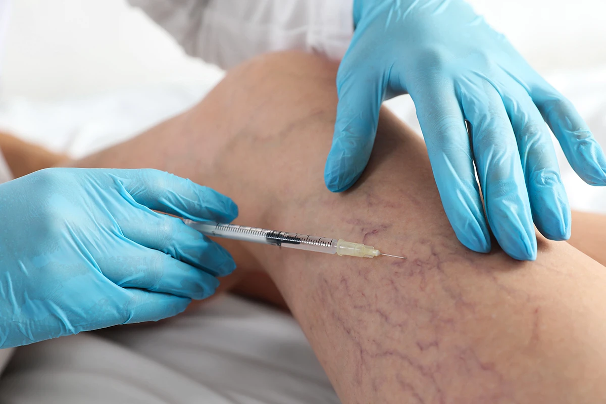 A woman receiving a leg vein treatment or sclerotherapy injection in a clinical setting.
